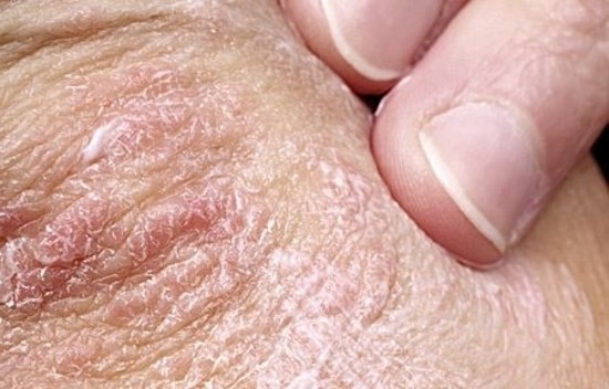 Metotreksat en las pastillas a la psoriasis